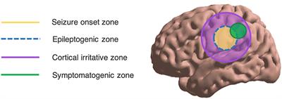 Can REM Sleep Localize the Epileptogenic Zone? A Systematic Review and Analysis